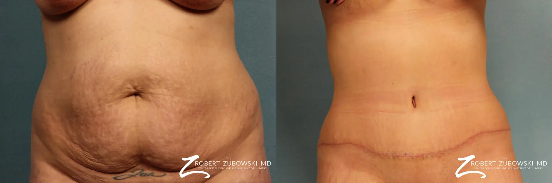 Tummy Tuck: Patient 5 - Before and After 1