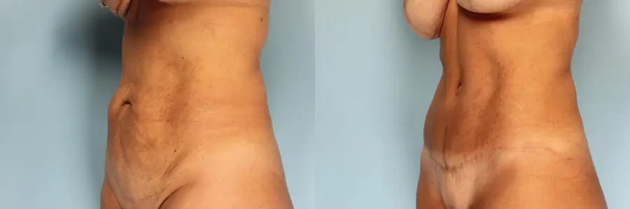 Tummy Tuck: Patient 23 - Before and After 2