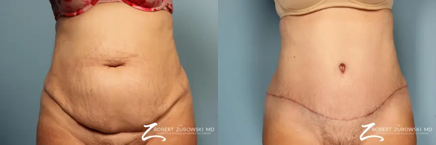 Tummy Tuck: Patient 16 - Before and After 1