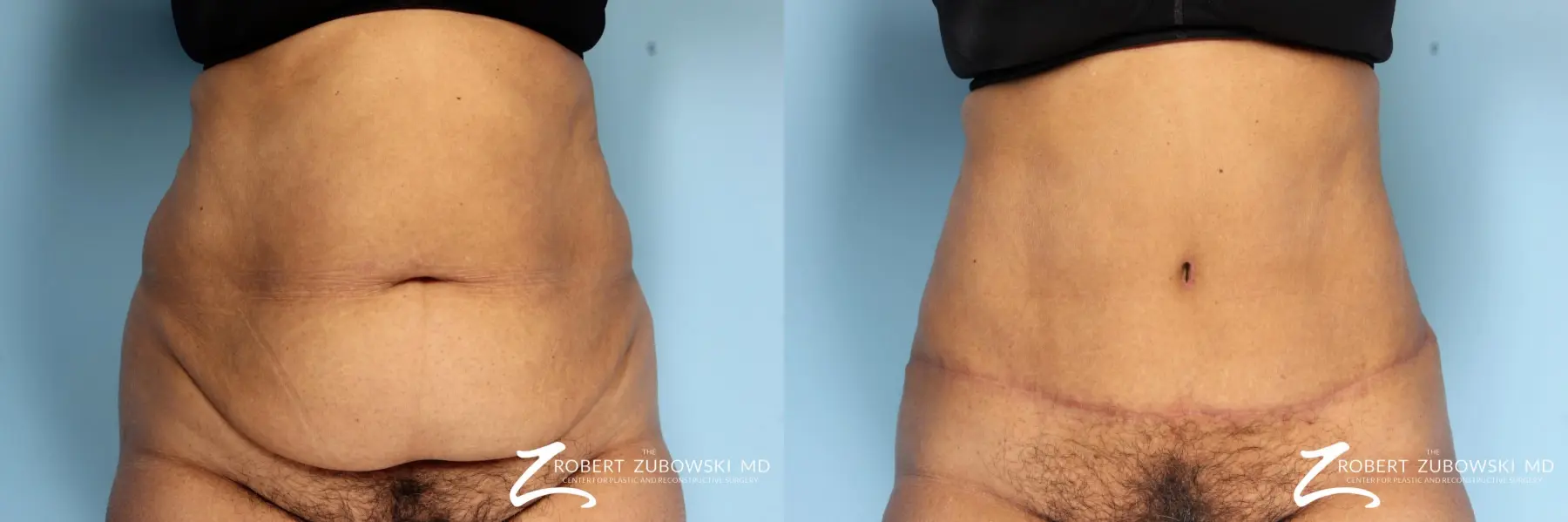 Tummy Tuck: Patient 18 - Before and After 1