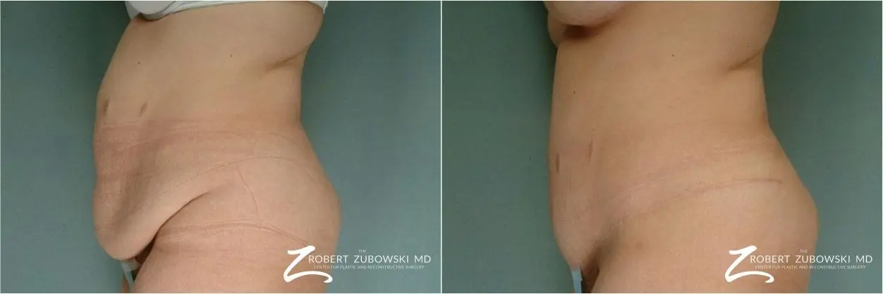 Tummy Tuck: Patient 2 - Before and After 2