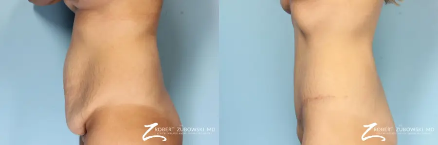 Tummy Tuck: Patient 25 - Before and After 2