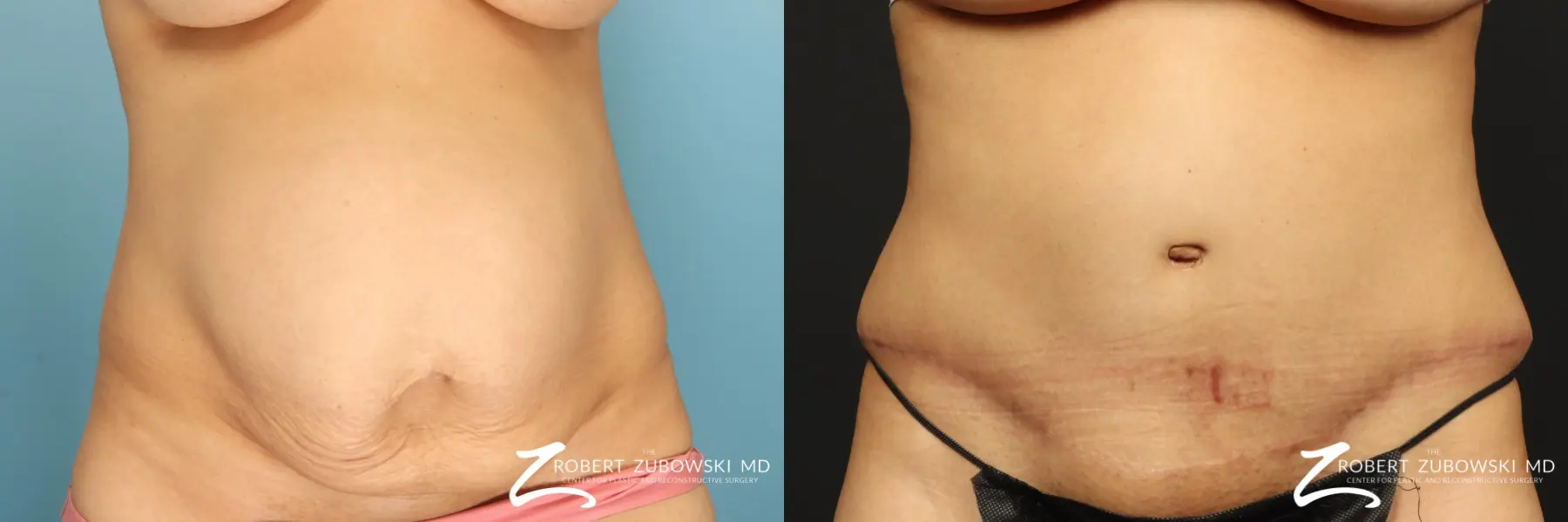 Tummy Tuck: Patient 29 - Before and After 1
