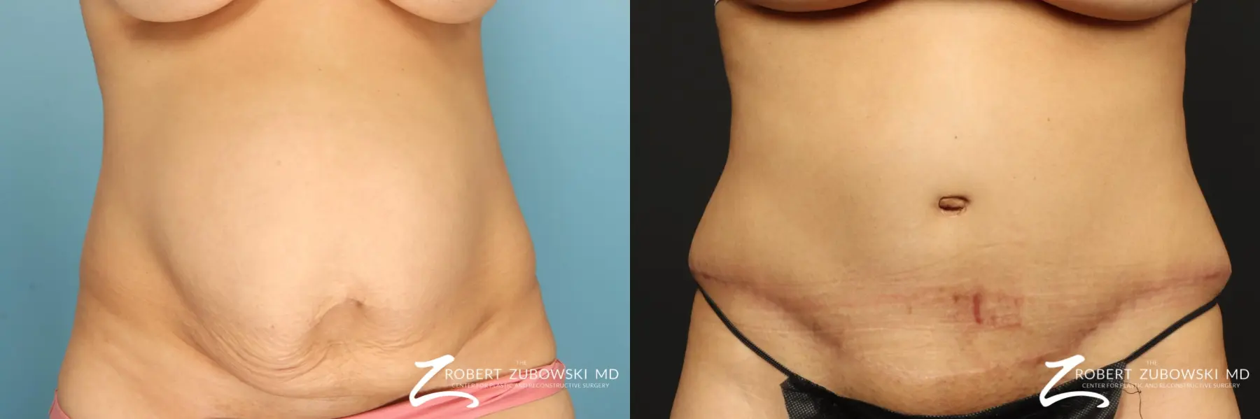 Abdominoplasty in Paramus, NJ, Tummy Tuck