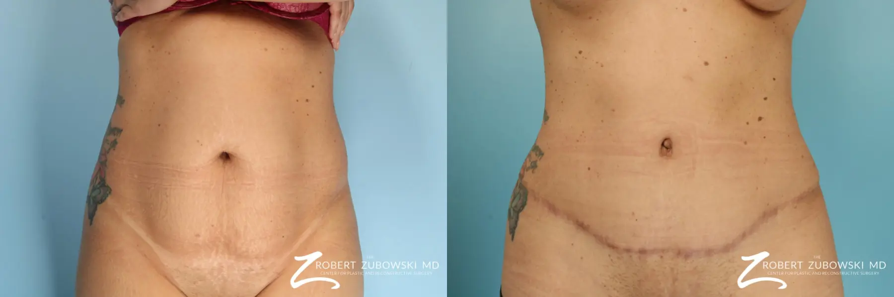 Tummy Tuck: Patient 28 - Before and After 1