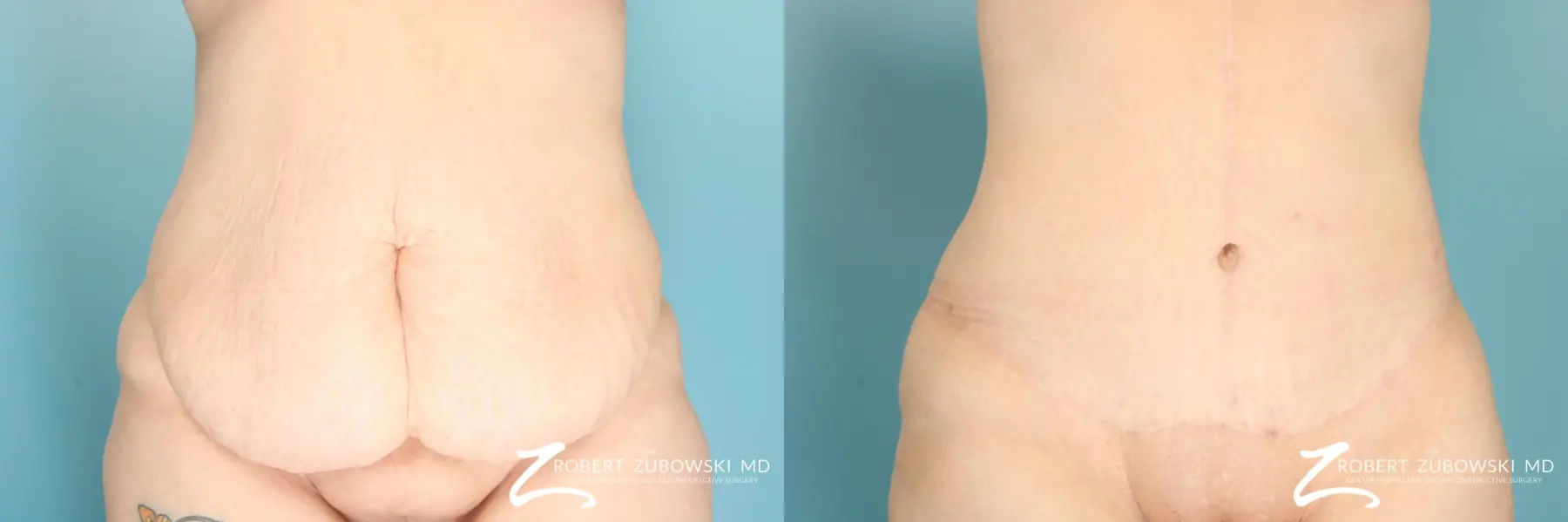 Tummy Tuck: Patient 26 - Before and After 1