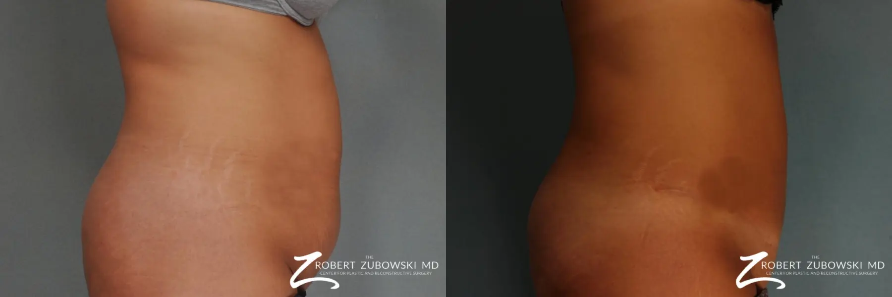 Tummy Tuck: Patient 21 - Before and After 2