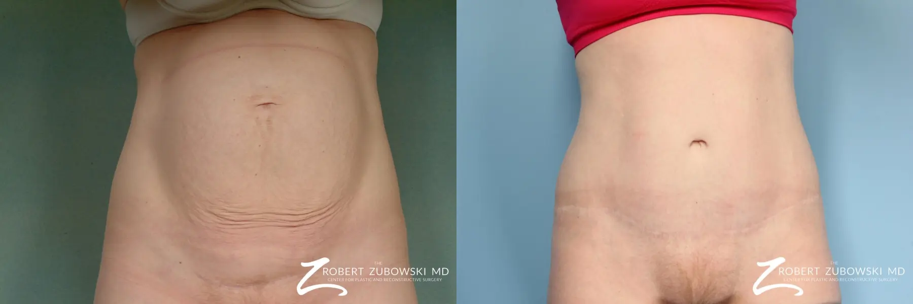 Tummy Tuck: Patient 7 - Before and After 1