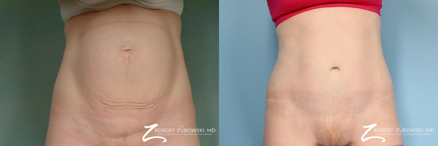 Tummy Tuck: Patient 7 - Before and After  