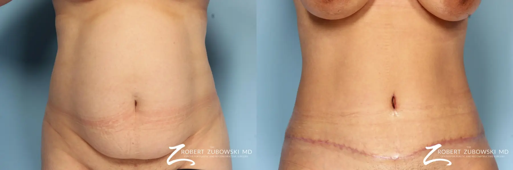 Tummy Tuck: Patient 20 - Before and After  