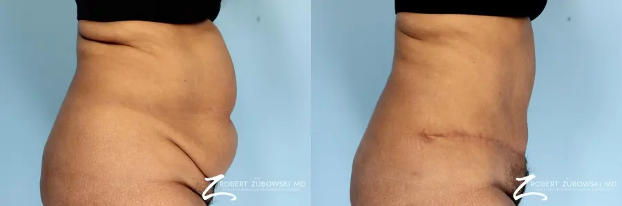 Tummy Tuck: Patient 18 - Before and After 2