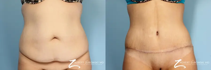 Tummy Tuck: Patient 17 - Before and After  