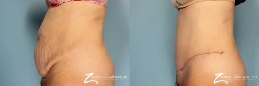 Tummy Tuck: Patient 16 - Before and After 2