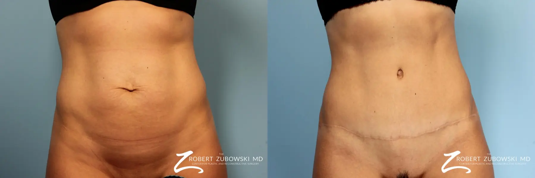 Tummy Tuck: Patient 14 - Before and After 1