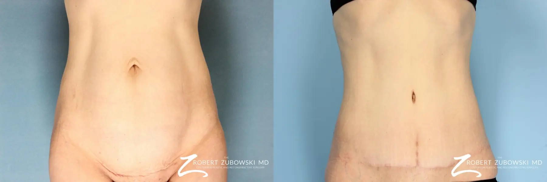 Austin Tummy Tuck