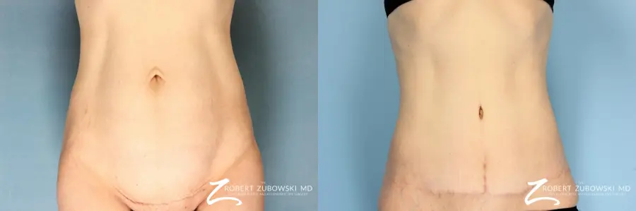 Tummy Tuck: Patient 12 - Before and After  
