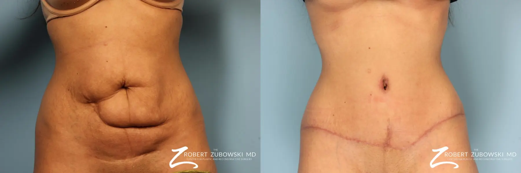 Tummy Tuck: Patient 10 - Before and After  
