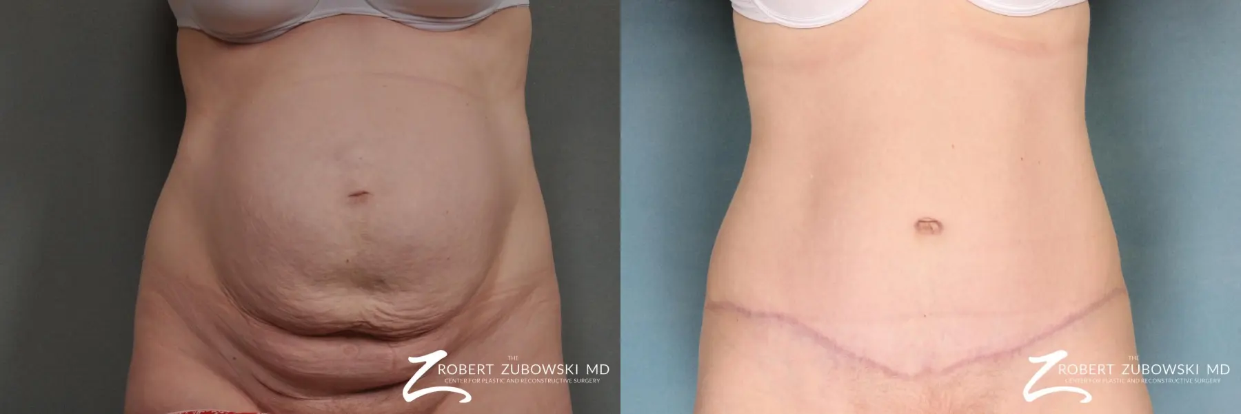 Tummy Tuck: Patient 6 - Before and After  