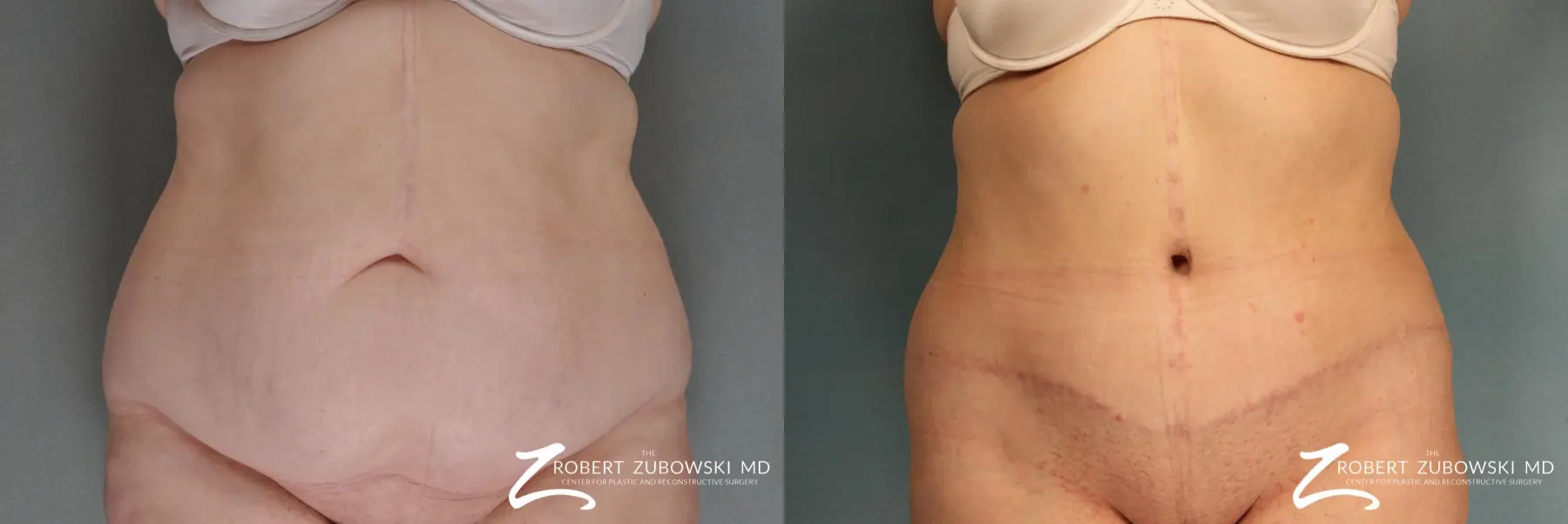 Tummy Tuck: Patient 1 - Before and After  