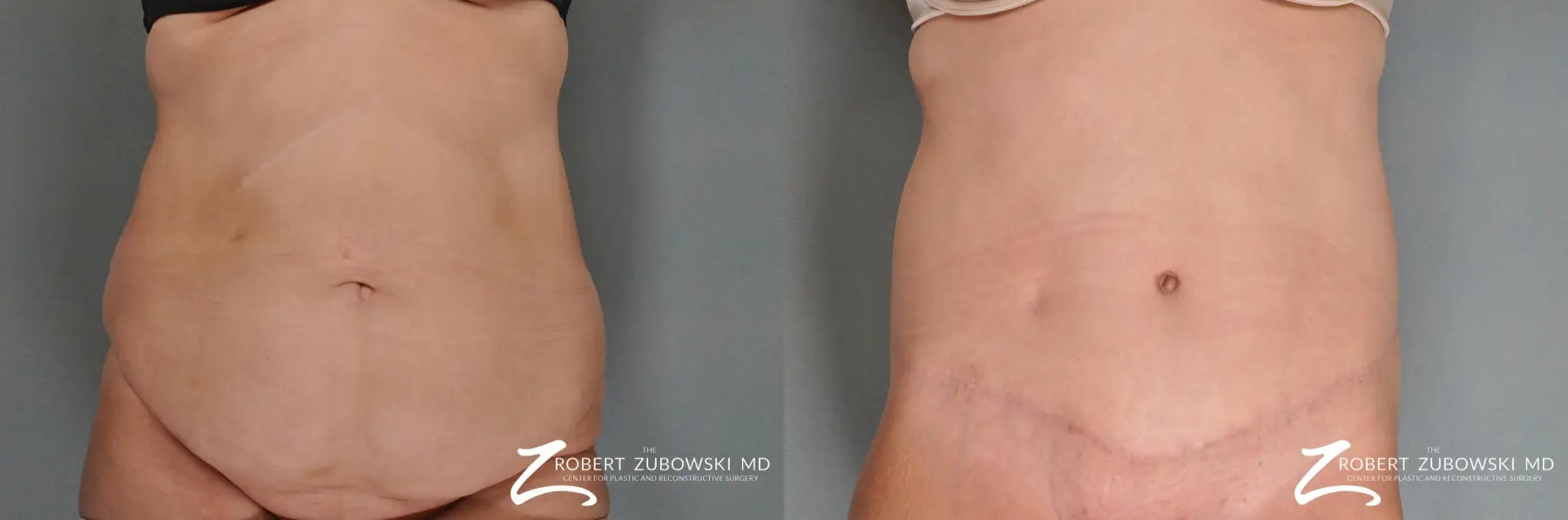 Tummy Tuck: Patient 9 - Before and After  