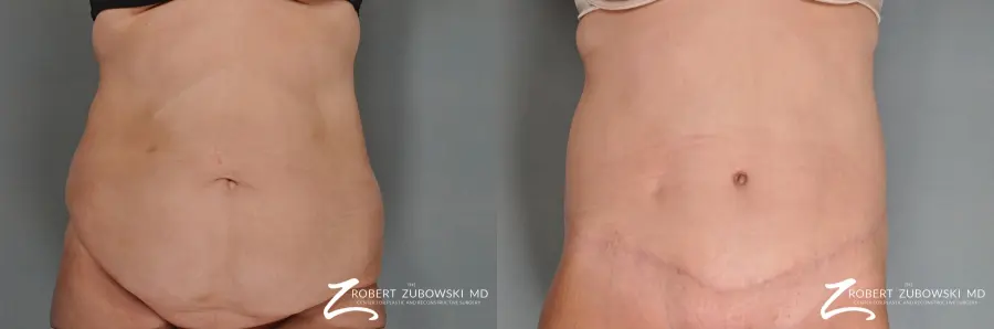 Tummy Tuck: Patient 7 - Before and After 1