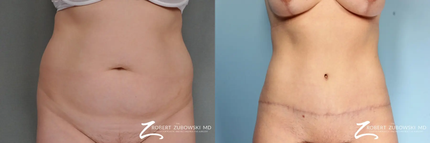 Tummy Tuck: Patient 4 - Before and After  