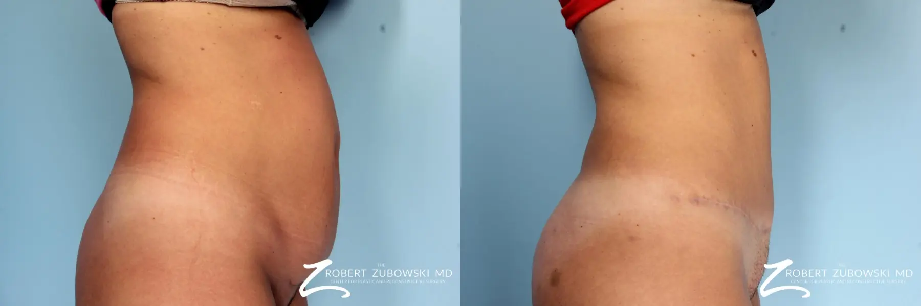 Tummy Tuck: Patient 11 - Before and After 2