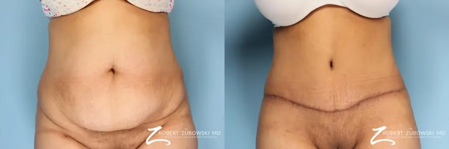 Tummy Tuck: Patient 15 - Before and After  