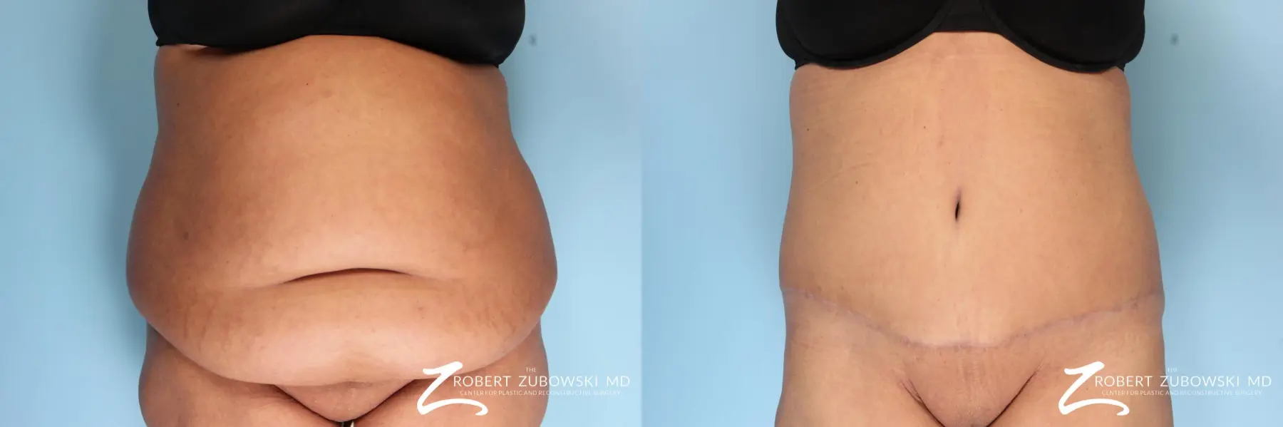 Tummy Tuck: Patient 19 - Before and After 1