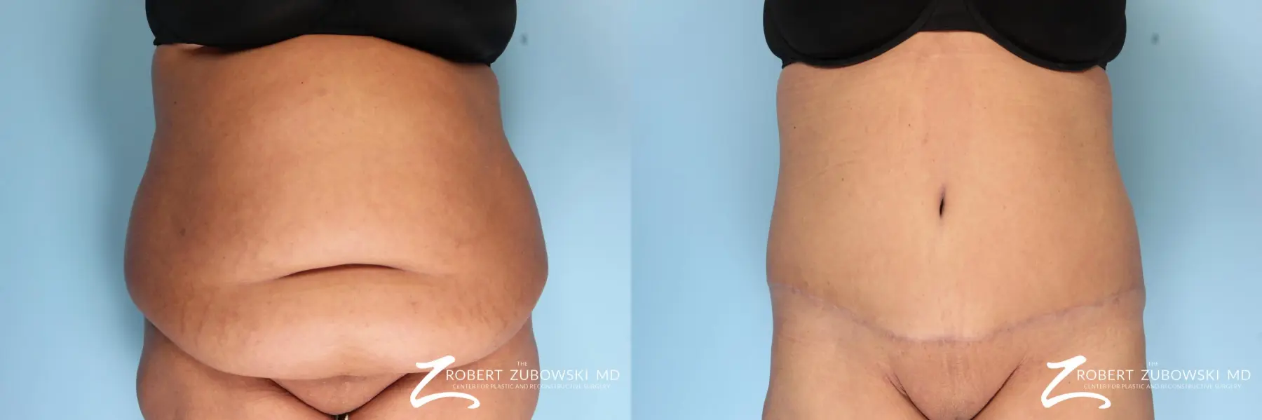 Tummy Tuck: Patient 19 - Before and After  