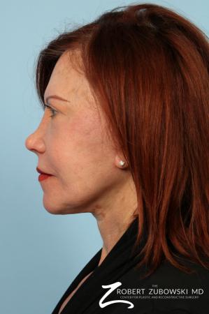 Facelift: Patient 29 - After Image 2