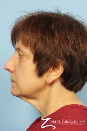 Blepharoplasty: Patient 14 - Before and After Image 3