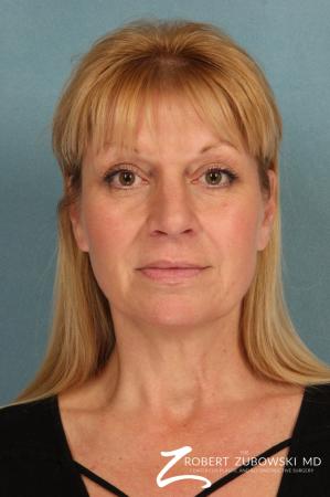 Rhinoplasty: Patient 17 - Before Image 1