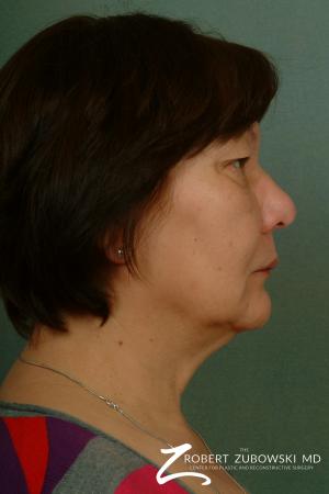Blepharoplasty: Patient 23 - Before and After Image 2
