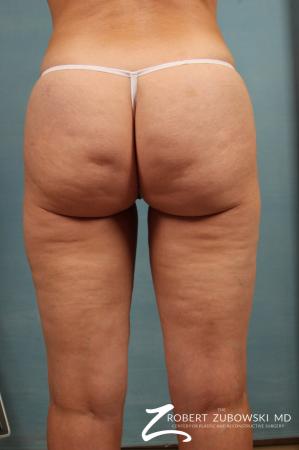 Cellulaze: Patient 1 - Before Image 2