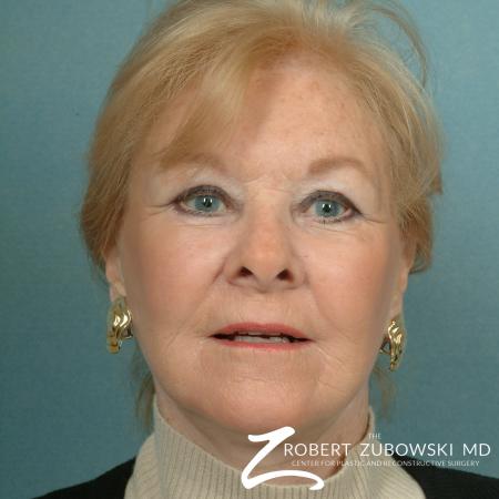 Facelift: Patient 16 - After Image 1