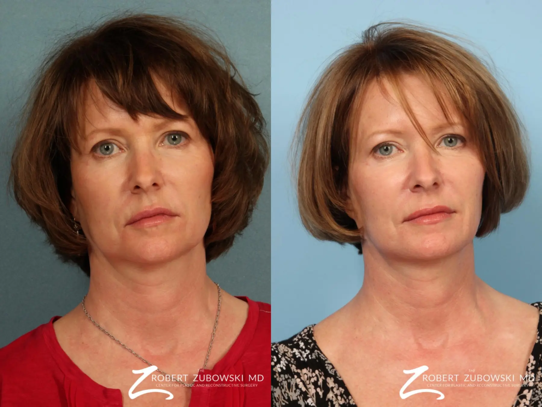 Ultherapy®: Patient 2 - Before and After  