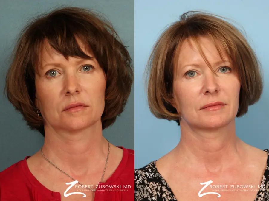 Ultherapy®: Patient 1 - Before and After  