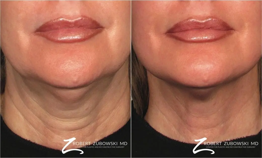 Ultherapy®: Patient 1 - Before and After  