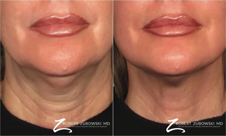 Ultherapy®: Patient 1 - Before and After 1