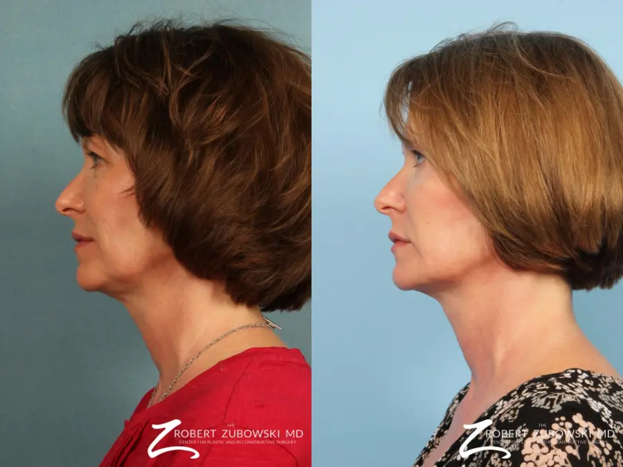 Ultherapy®: Patient 2 - Before and After 2