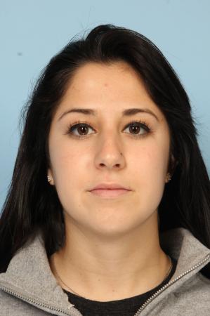 Rhinoplasty: Patient 20 - After Image 1