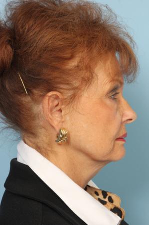 Blepharoplasty: Patient 12 - Before and After Image 2