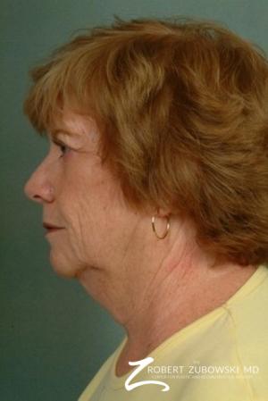 Facelift: Patient 10 - Before and After Image 2