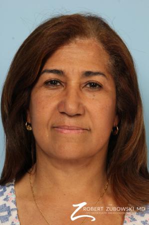 Brow Lift: Patient 8 - After Image 1