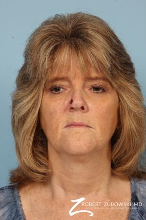 Mohs Closure: Patient 5 - Before Image 1
