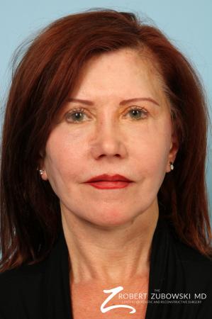 Facelift: Patient 29 - After Image 1