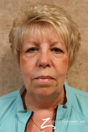 Blepharoplasty: Patient 5 - Before Image 1