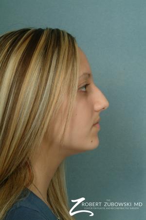 Rhinoplasty: Patient 9 - Before and After Image 2