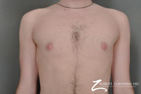 Gynecomastia: Patient 4 - After Image 1